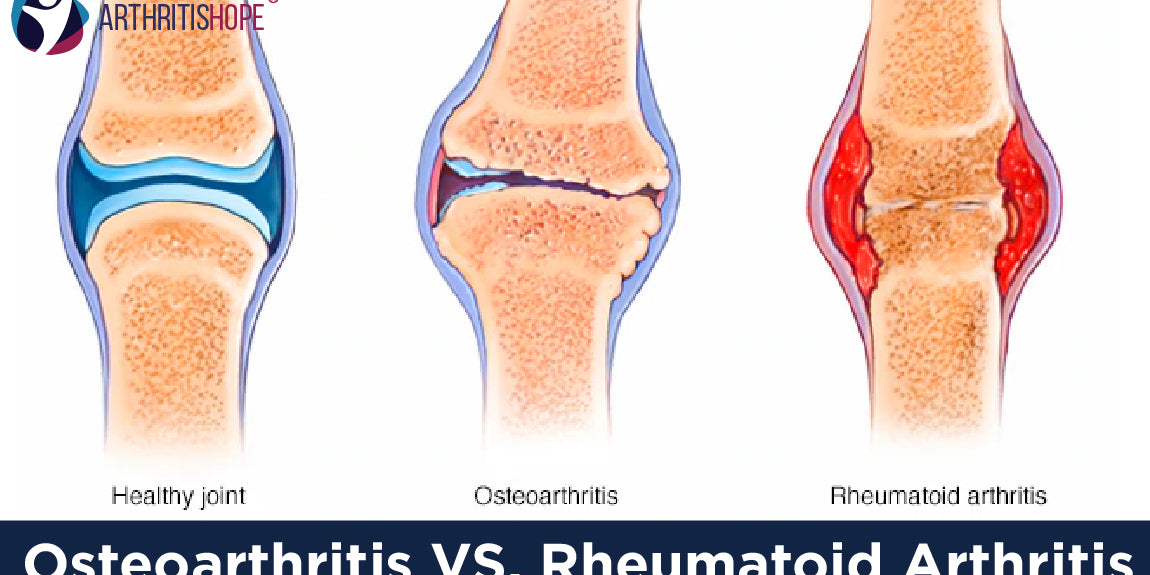 Osteoarthritis VS Rheumatoid Arthritis